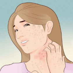 Eczema (Itching)